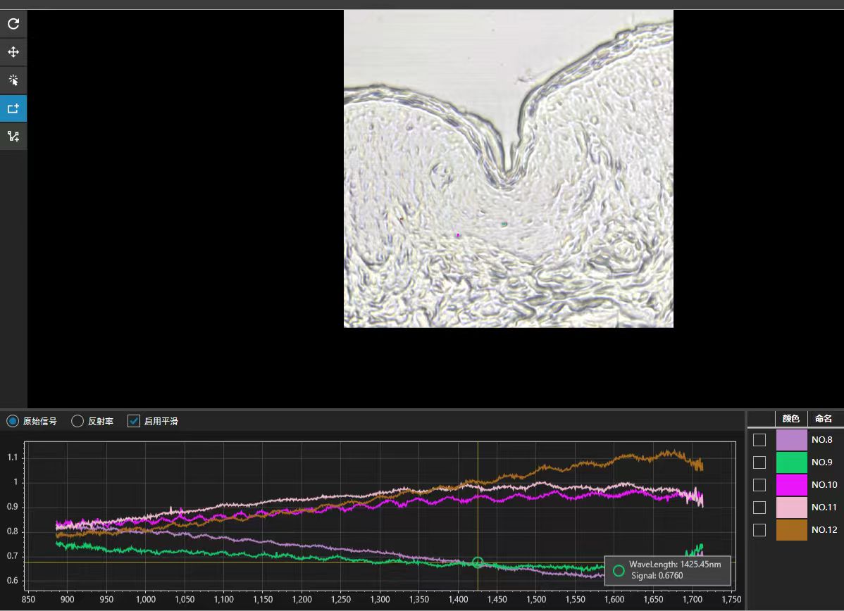 黑色素瘤与色素痣的早期鉴别